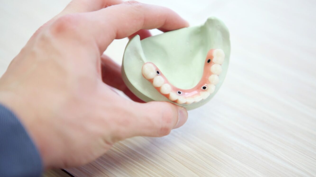 Teeth Bonding: What To Expect If You Have Your Teeth Bonded