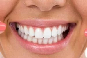 Six Month Smiles – Is It Right For You?
